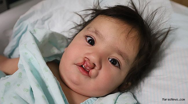 9 Aylık Muhammet bebek, Türk Lalesi tekniğiyle sağlığına kavuştu